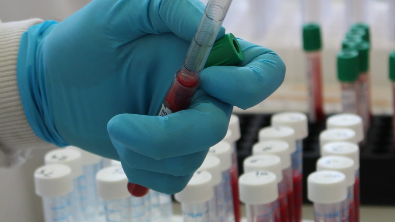 NFU welcomes voluntary blood testing for TB